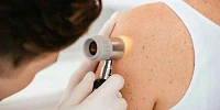 Dermatologia Cancer de Piel