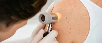 Dermatologia Cancer de Piel